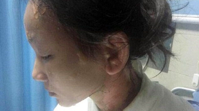 Cô gái tên Lin bị bồi bàn dội nước sôi lên đầu