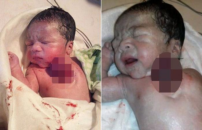 Bé gái sinh ra có trái tim nằm ngoài lồng ngực