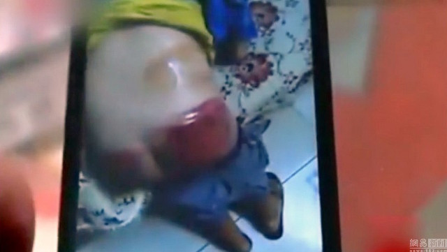 Bé lớp 4 bị thầy đánh bầm mông vì không làm bài tập về nhà