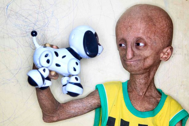 Bé trai 14 tuổi già như ông lão vì mắc bệnh lạ