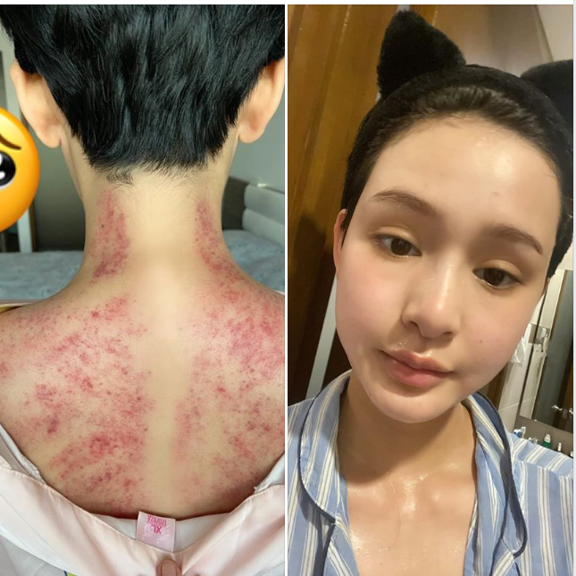 Fan hoảng hốt trước ảnh Hiền Hồ nhợt nhạt, lưng chằng chịt vết đỏ tím