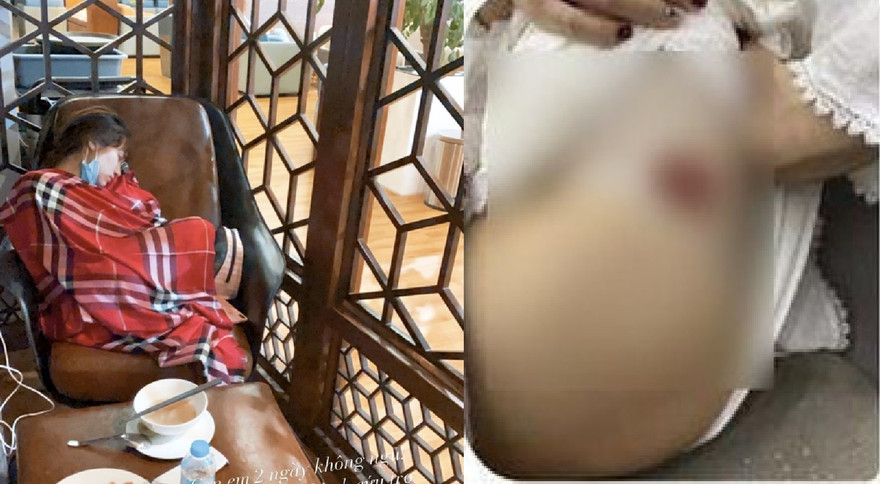 Hòa Minzy kiệt sức, tiêm 15 mũi thuốc/tuần 