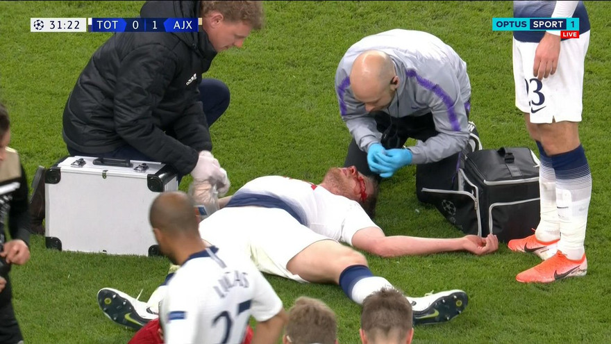 Jan Vertonghen đổ gục với gương mặt đầy máu