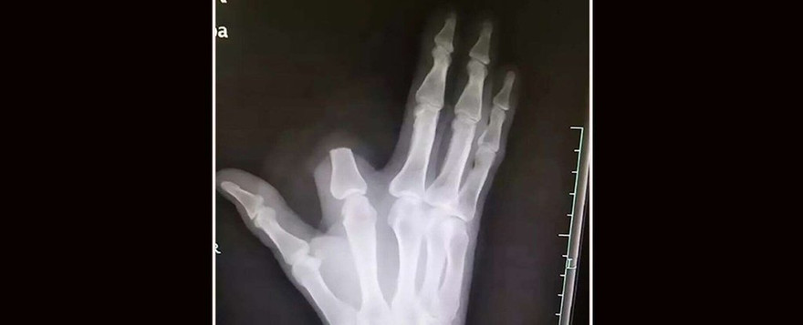 Người đàn ông Trung Quốc chặt ngón tay sau khi bị rắn cắn