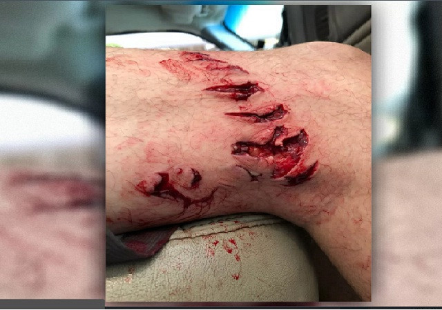 Nhiễm “vi khuẩn ăn thịt người” sau khi bị cá mập cắn