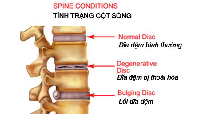 Thoái hóa đĩa đệm với sự hình thành gai xương