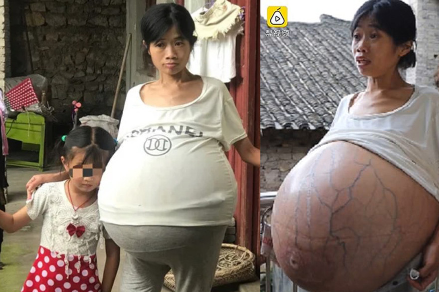 Người phụ nữ gây sốc vì bụng phình khổng lồ suốt 2 năm không rõ nguyên nhân