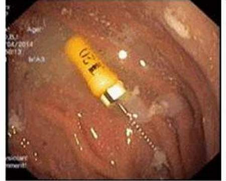 Cây kim trong dạ dày cháu bé. 