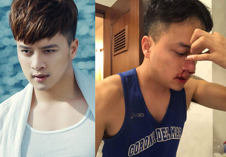 Cao Thái Sơn nhập viện khẩn cấp vì chảy máu mũi không ngừng