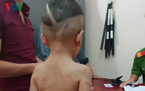 bé Lê Hoàng Huy với nhiều thương tích trên người