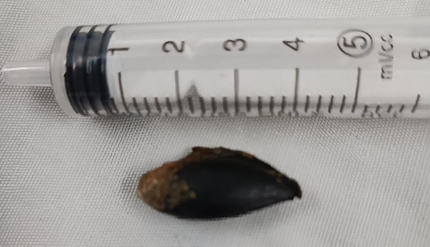 Lấy thành công hạt hồng xiêm 26 năm 'nằm' trong phế quản cụ ông