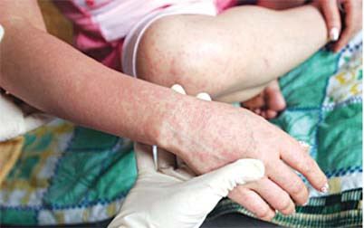 Bệnh sởi tái xuất sau 3 năm không có dịch