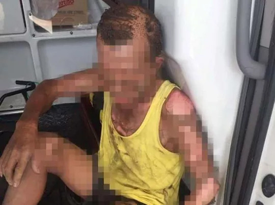 Ông P. bị bỏng toàn thân đang được cấp cứu tại bệnh viện 