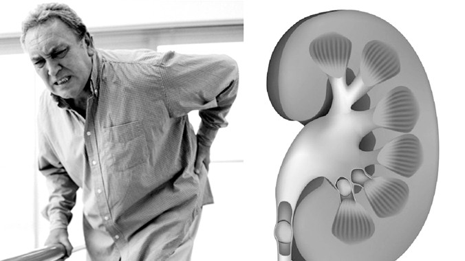 Bệnh thận ảnh hưởng đến chất lượng cuộc sống