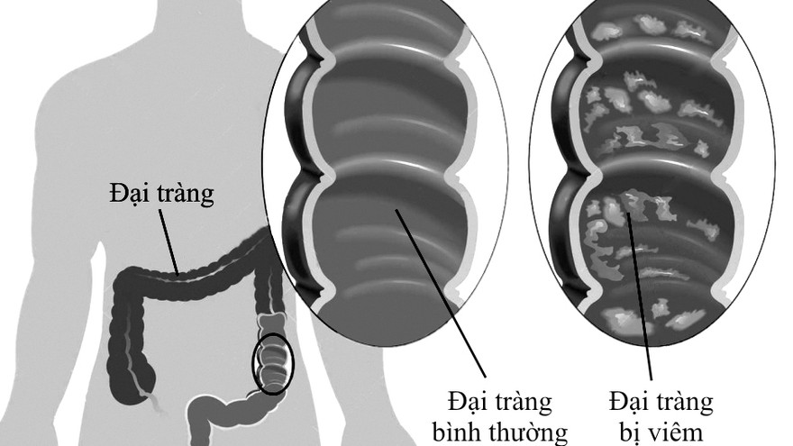 Mô phỏng đại tràng bình thường và đại tràng bị viêm