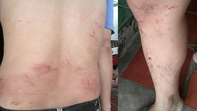 Nhiều vết thương trên người anh Quý