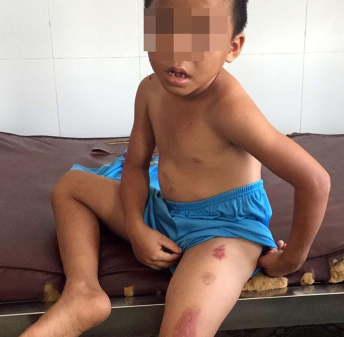 Vết thương trên người bé H.