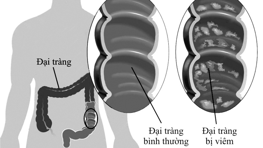 Mô phỏng đại tràng bình thường và đại tràng bị viêm
