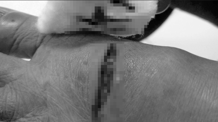 Một người bị con chó cắn bị thương