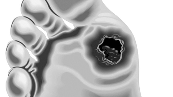 Bàn chân biến chứng tiểu đường