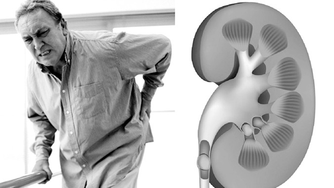 Bệnh thận ảnh hưởng đến chất lượng cuộc sống