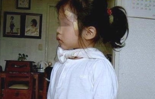  Bé gái bốn tuổi có 2 bộ phận sinh dục nam, nữ 