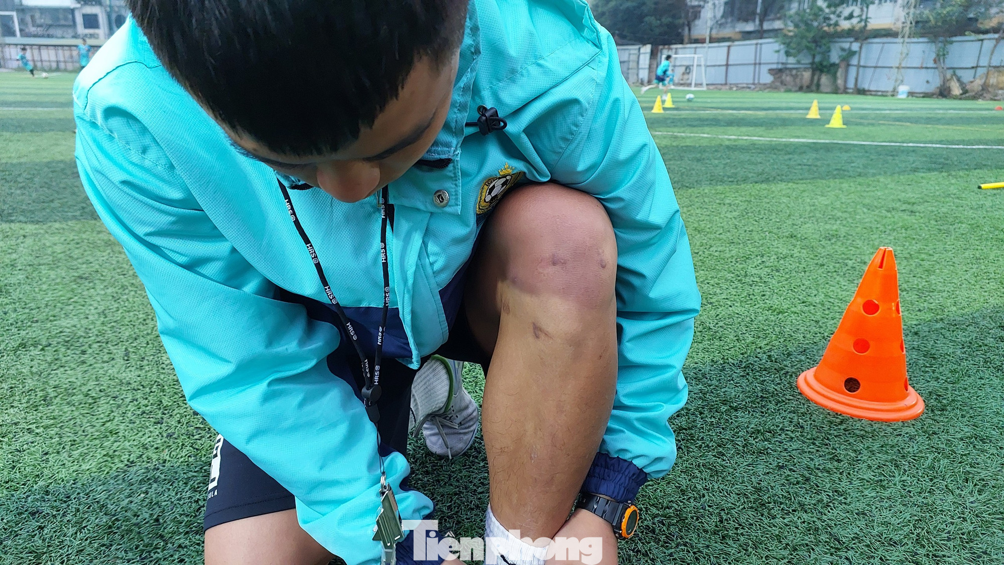 Có thể thấy đầu gối chịu nhiều tổn thương với hai lần phẫu thuật của Thái Sung. Có thể thấy đầu gối chịu nhiều tổn thương với hai lần phẫu thuật của Thái Sung.