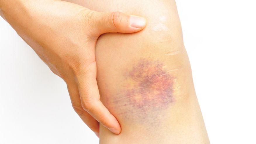 V&igrave; sao bạn hay bị bầm t&iacute;m hơn những người kh&aacute;c? | B&aacute;o điện tử Tiền Phong