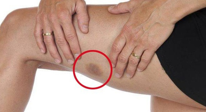 Vết bầm t&iacute;m bất thường tr&ecirc;n da cảnh b&aacute;o nhiều bệnh nguy hiểm | B&aacute;o điện tử  Tiền Phong