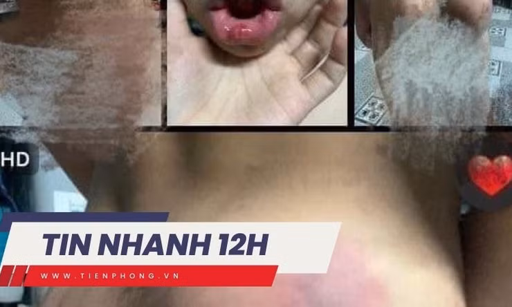 TIN NHANH 12H: Công an vào cuộc vụ cháu bé bị cô giáo đánh chảy máu miệng, sưng đầu