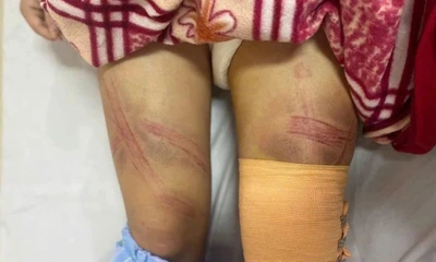 Nữ sinh lớp 7 ở Nghệ An nhập viện nghi do bị bố bạo hành