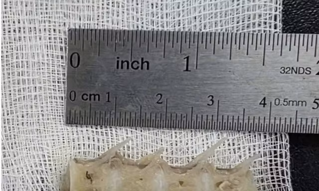 Lấy xương cá 'khủng' găm chặt vào thực quản của cụ ông 99 tuổi