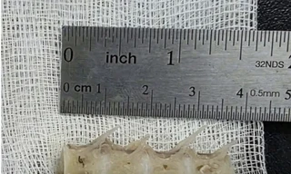 Lấy xương cá 'khủng' găm chặt vào thực quản của cụ ông 99 tuổi