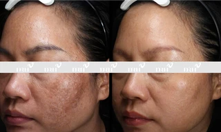 DRH Clinic hỗ trợ miễn phí xử lý biến chứng kem trắng nhanh, kem gây nghiện