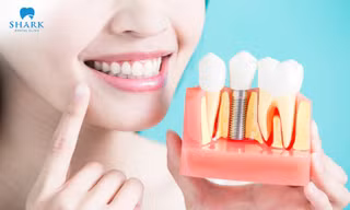 Những thông tin quan trọng về cấy ghép Implant