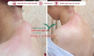 Đau vai gáy dai dẳng cảnh báo thoái hóa đốt sống cổ từ thói quen xấu