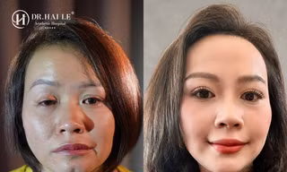Bệnh viện Hải Lê và hành trình 9 năm đồng hành cùng những ca mí lỗi, mí hỏng phức tạp