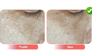 Edopi Clinic - giải pháp trẻ hóa da bằng ánh sáng tinh khiết