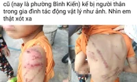 Công an vào cuộc vụ bé trai 10 tuổi ở Đắk Lắk chi chít vết thương gây xôn xao dư luận