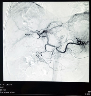 Cụ ông vỡ u gan, máu tràn ngập ổ bụng mà không hề biết ảnh 2