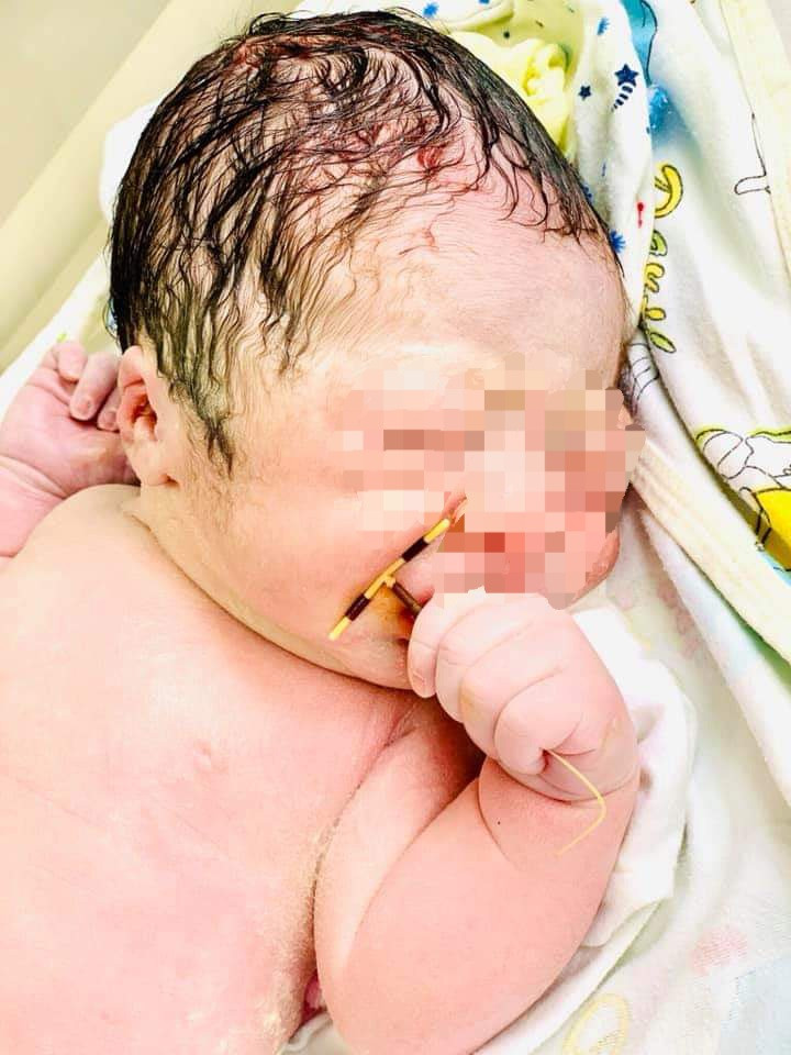 Hy hữu bé trai chào đời cùng vòng tránh thai của mẹ ảnh 2