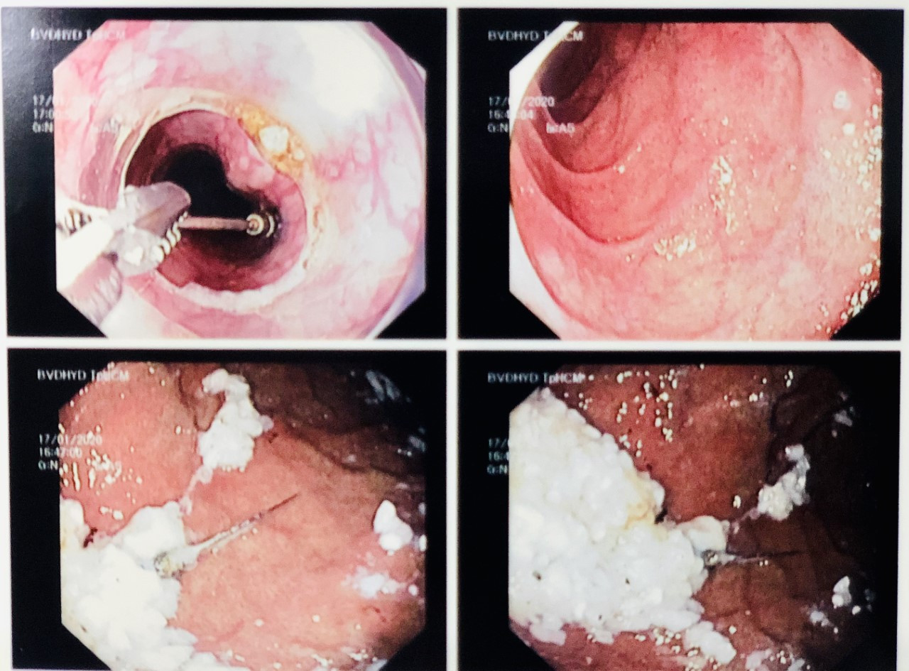 Đang chữa răng, bệnh nhân bất ngờ nuốt luôn kim vào bụng ảnh 1