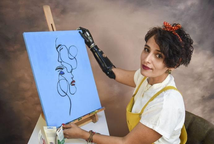 4 lần thoát chết, cô gái trẻ vẫn vững tin vào cuộc sống với cánh tay giả là bạn đồng hành ảnh 5