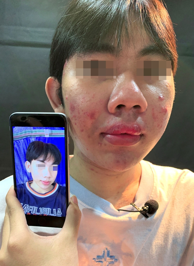 Kinh hoàng 10X tự tiêm silicon làm đẹp, trào chỗ nào dán 'keo con voi' chỗ đó ảnh 1