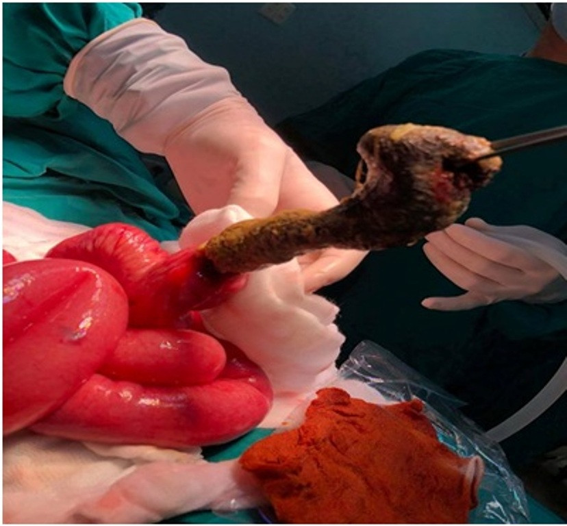 Bé gái 8 tuổi bị tắc ruột vì hội chứng 'nghiện ăn tóc' ảnh 1