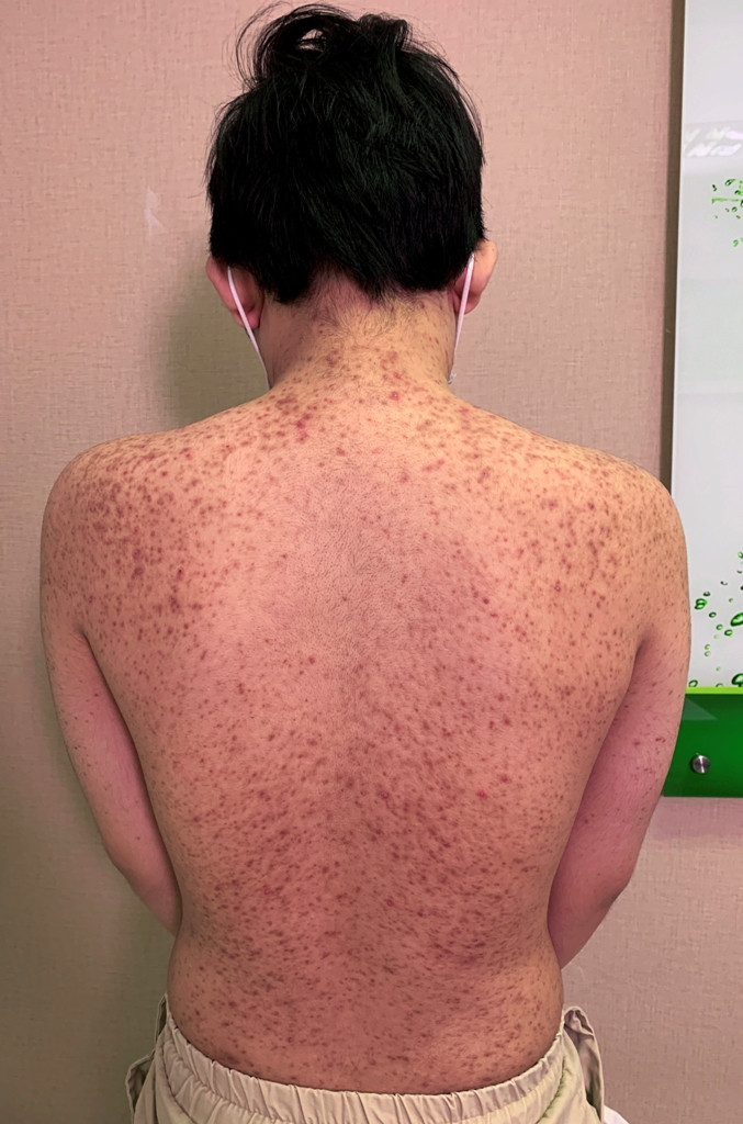 Kinh hoàng 10X tự tiêm silicon làm đẹp, trào chỗ nào dán 'keo con voi' chỗ đó ảnh 2