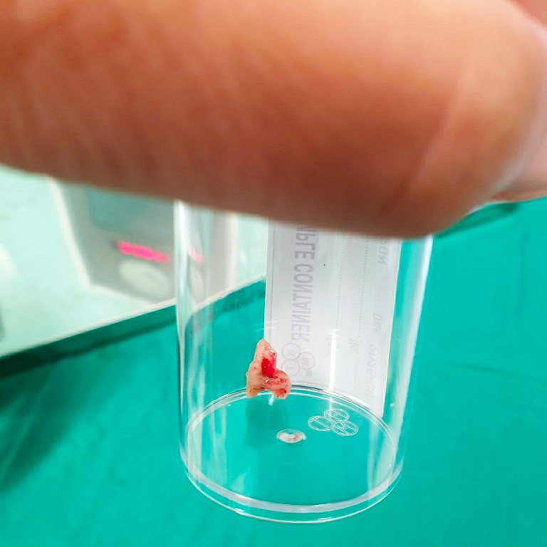 Bé gái ở TPHCM được phát hiện có răng trong phổi sau cơn ho dài... 2 tháng ảnh 1