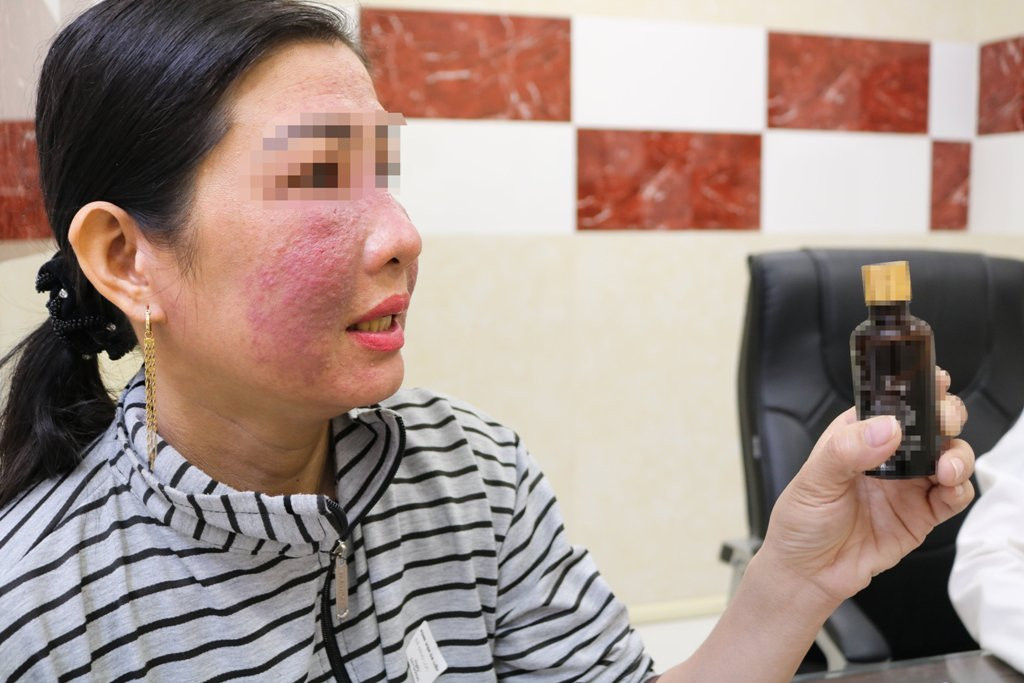 Chai thuốc làm trắng da khiến da mặt chị H. như "dề cơm cháy" (ảnh: BVCC) Sưng phù mặt, mụn kết tảng do làm trắng da cấp tốc ảnh 2