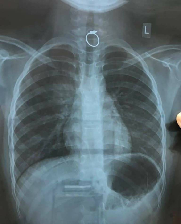 Được tặng nhẫn, bé gái nuốt trôi xuống họng ảnh 1