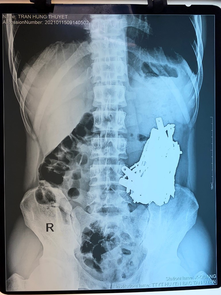 Bác sĩ 'choáng' khi phát hiện vô số đinh, thìa, lưỡi dao trong bụng nam bệnh nhân ảnh 1